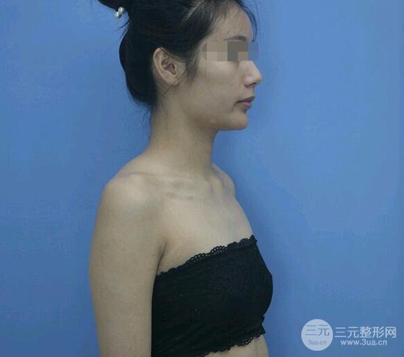 自体脂肪填充胸部可以维持多久?