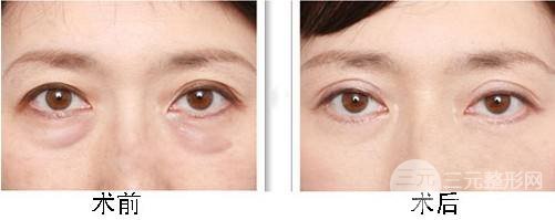 吸脂除去眼袋果好不好
