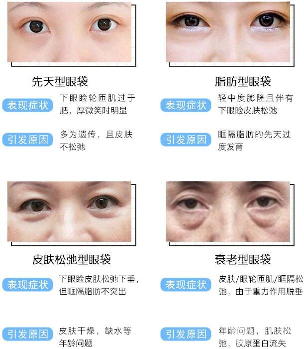 眼袋种类