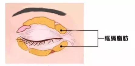 吸脂除去眼袋手术