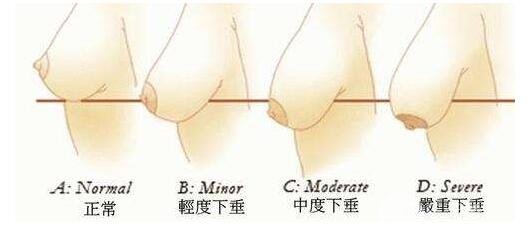 胸部下垂整形多少钱?