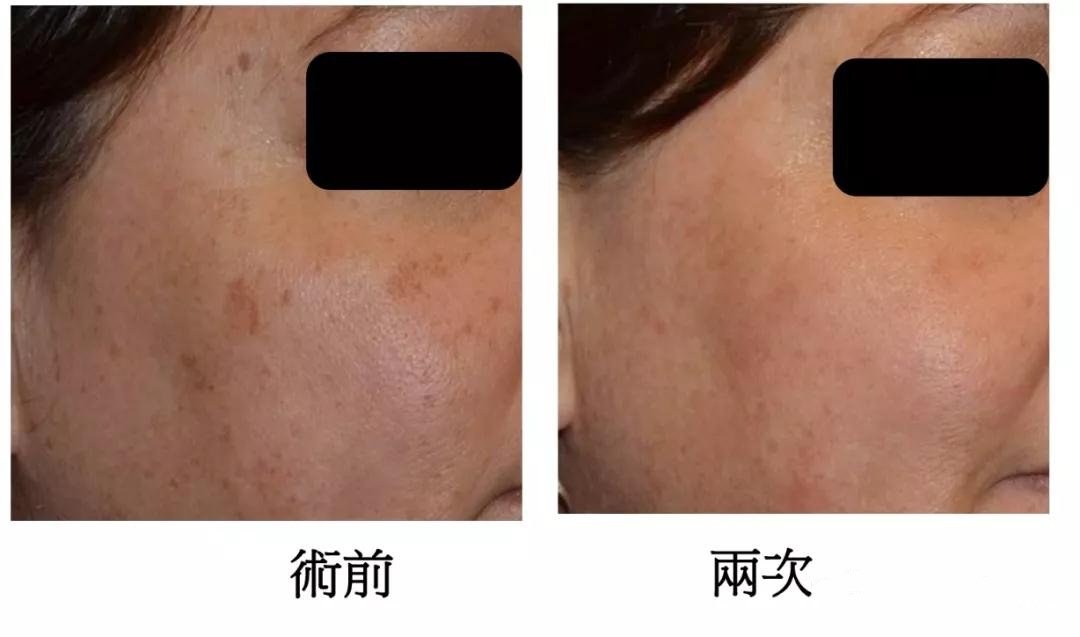 超蜂巢果图