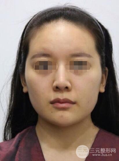 下颌角整形案例术前