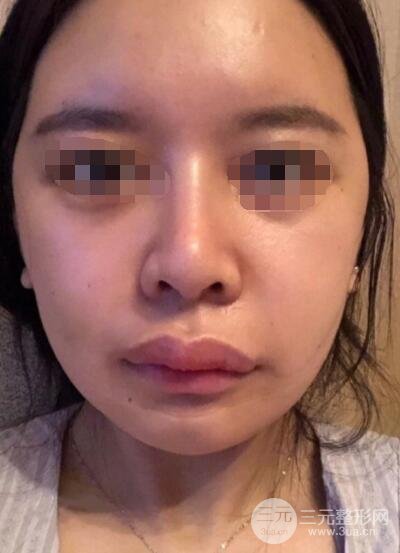 下颌角整形案例术后2周