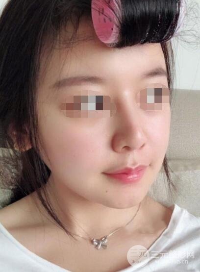 下颌角整形案例术后5周