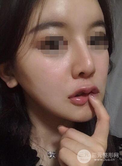 下颌角整形案例术后12周