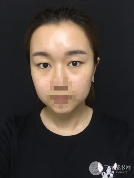 缝线双眼皮案例术前