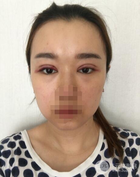 缝线双眼皮案例术后1周