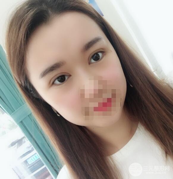缝线双眼皮案例术后3周