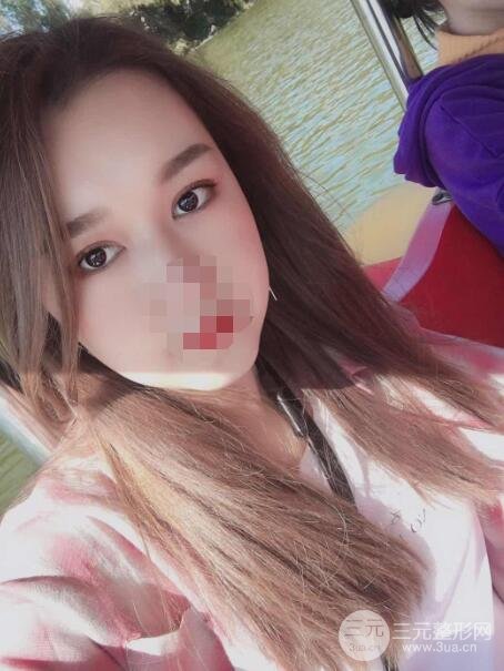 缝线双眼皮案例术后9周