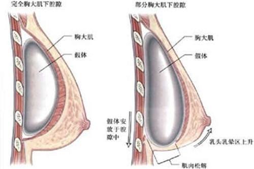 假体美胸手术