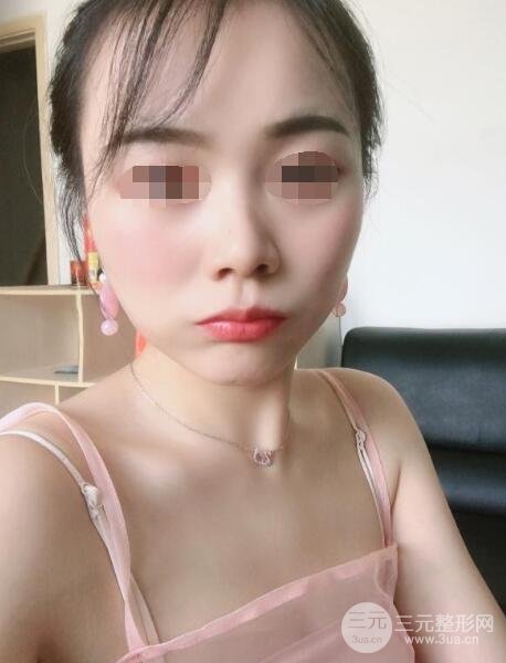 打注射瘦脸真实案例术后一个月