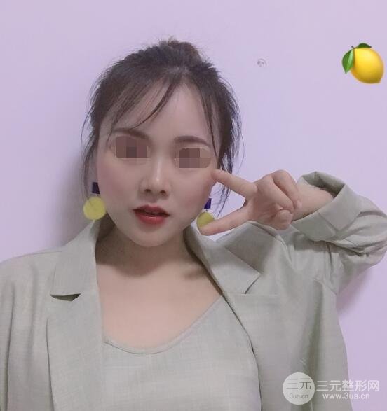 打注射瘦脸真实案例术后3个月