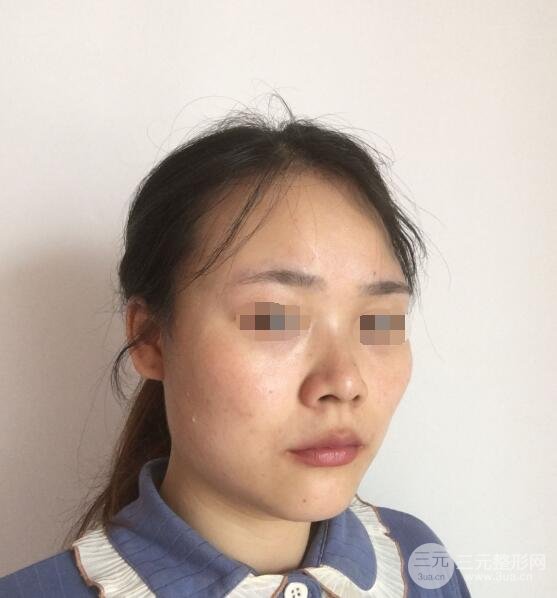 打注射瘦脸真实案例术前