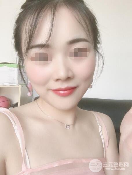 打注射瘦脸真实案例术后一个月