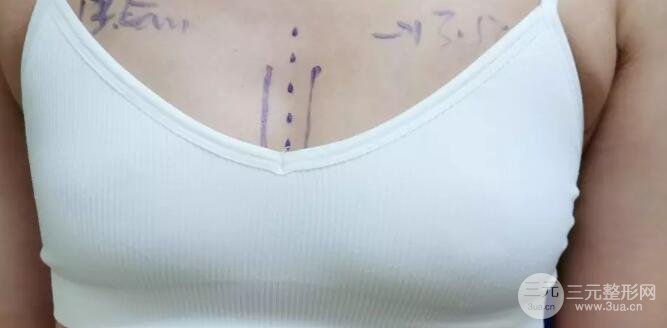 丰胸假体有哪些牌子？可以一辈子吗？