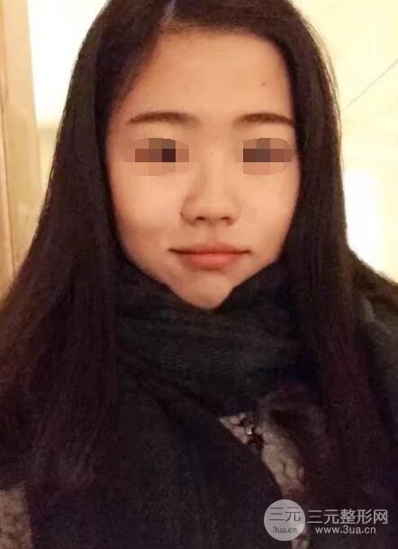 人工假体隆鼻案例术前