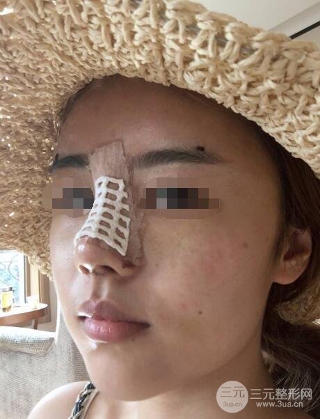 人工假体隆鼻案例术后2周