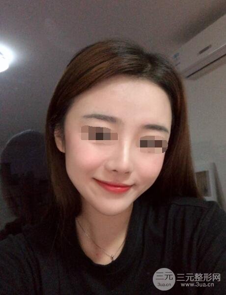 人工假体隆鼻案例术后6周