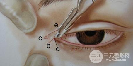 割双眼皮开眼角需要多少钱