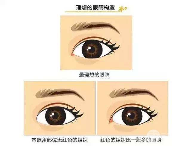 割双眼皮开眼角手术注意事项