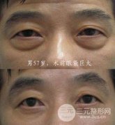 如何去眼袋？不同手术方式及眼袋形成原因