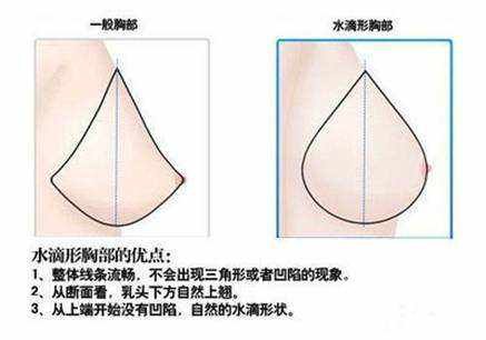 水滴型假体优点