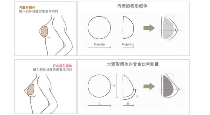 哪种假体好