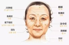 面部下垂怎么办?埋线除皱提升帮你重回青春精致! 面部下垂怎么办?埋线除皱提升帮你重回青春精致!