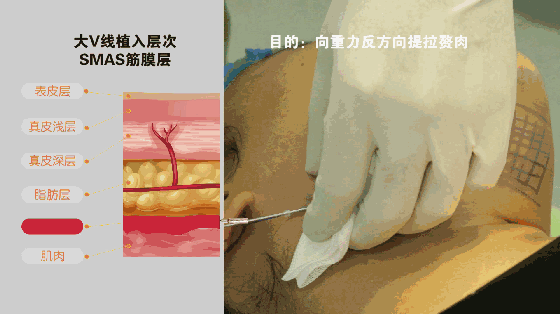 埋线除皱手术过程