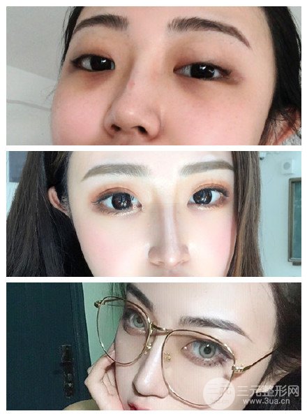 自体耳软骨隆鼻果图