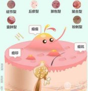 医美祛痘缓解|方式有几种？怎么选择？超全科普告别痘肌！