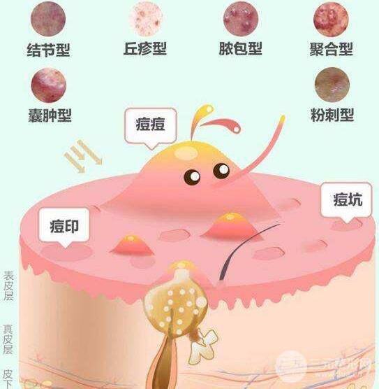痘痘类型