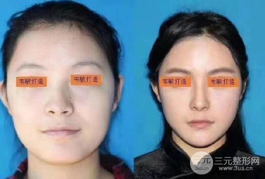 做改脸型术果好不好