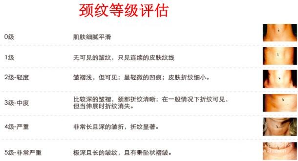 颈纹严重程度