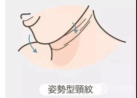 颈纹类型