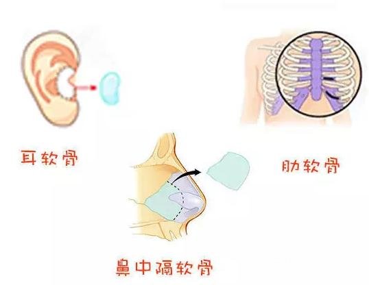 垫鼻子的材料有哪些