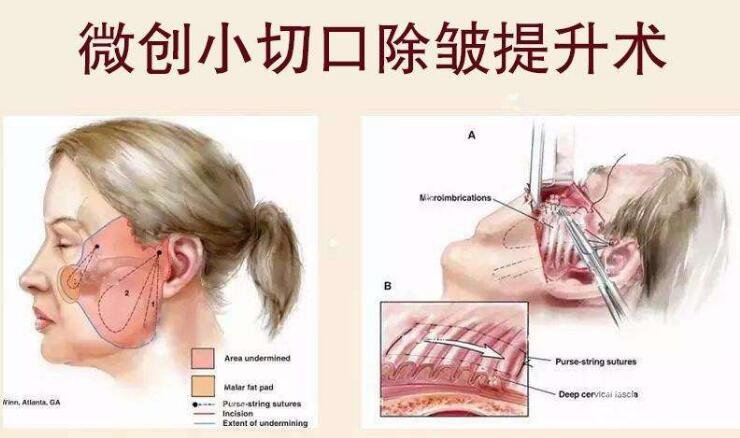 手术原理