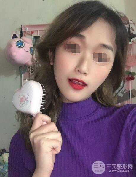 脸颊吸脂案例