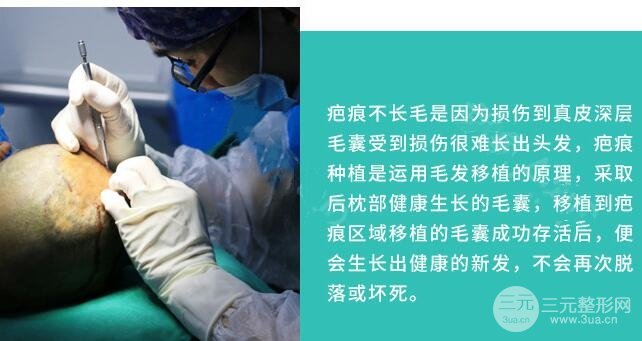 疤痕头发种植原理