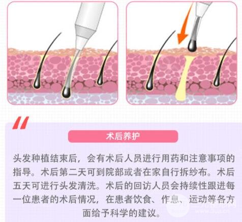 植发过程