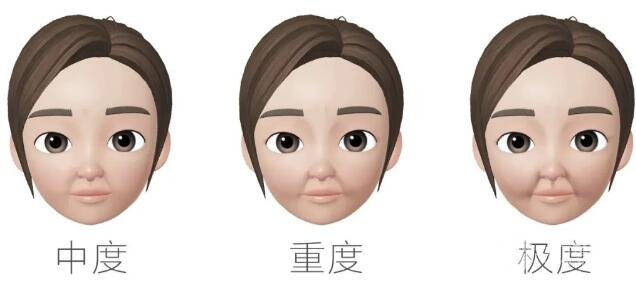 法令纹严重等级
