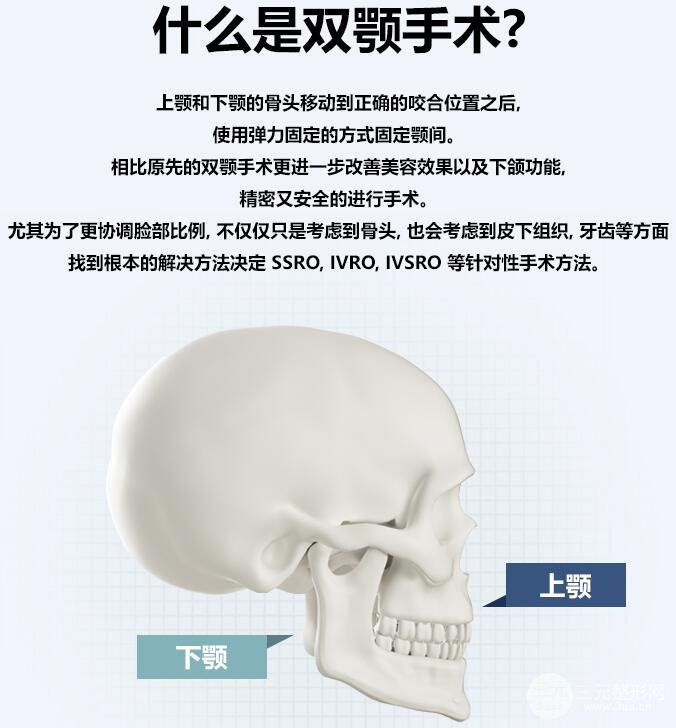 什么是韩国双鄂手术
