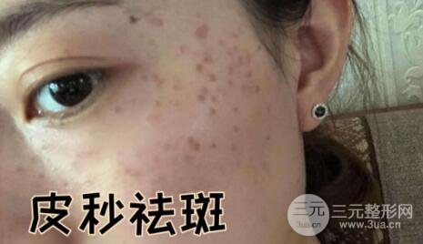 蜂巢激光祛斑案例术前