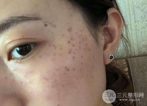 蜂巢激光祛斑案例术后一个月