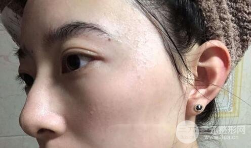 蜂巢激光祛斑案例术后2个月