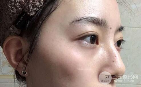 蜂巢激光祛斑案例术后4个月