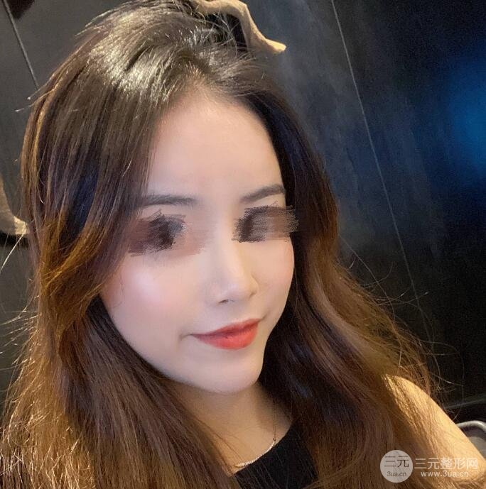 硅胶假体隆鼻果图