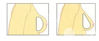 上海九院隆胸大概多少钱?几有做呢?