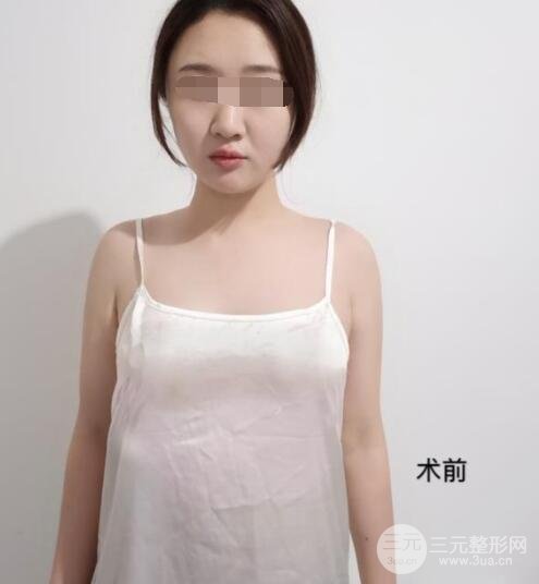 上海九院隆胸案例术前